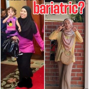 kurus sebab bariatric